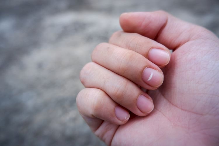 Tanda Putih di Kuku Bukan Pertanda Ada yang Rindu