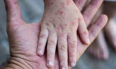 Waspadai Cacar Monyet, Pakar Usul Pemerintah Waspada Kedatangan dari Afrika