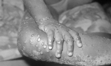 Kemenkes Sebut Kasus Cacar Monyet Belum Ditemukan di Indonesia