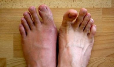 10 Tips Hilangkan Nyeri Asam Urat Cepat dan Mudah