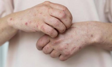 Ada 122 Penderita Sifilis di Riau, Kasus Terbanyak di Dumai dan Inhil