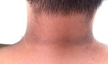 Tanda Diabetes yang Terlihat di Kaki, Leher, dan Ketiak