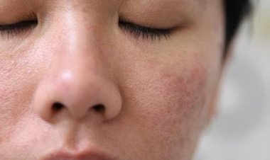 Skin Barrier Adalah Lapisan Terluar Kulit, Ini Ciri-ciri dan Penyebab Kerusakannya