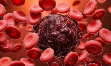 Mengenal Kanker Darah dan Macam-Macam Pengobatannya