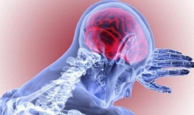 Stroke Bisa Serang Usia Muda 20-30 Tahun, Ini Penyebabnya Kata Ahli Saraf