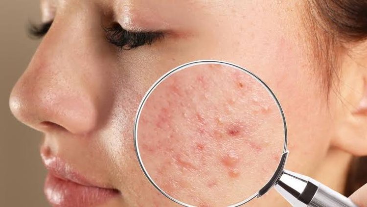 Polusi Bikin Wajah Gampang Jerawatan, Ini Skincare Saran Dokter Kulit