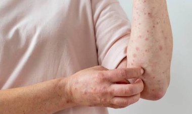 Cegah Cacar Monyet, Dinkes Pekanbaru Himbau Warga Terapkan PHBS