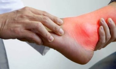 Waspada Ini Makanan Penyebab Asam Urat