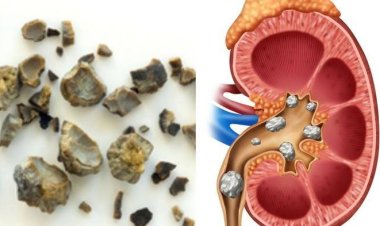 5 Kebiasaan Sepele Ini Bisa Picu Batu Ginjal, Stop Sekarang!