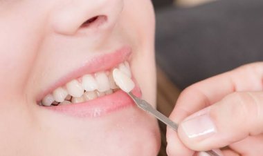 Veneer Kerap Dihubungkan dengan Bau Mulut, Apa Penyebabnya?