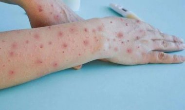 Virus Mpox Belum Masuk ke Riau, Kadiskes Minta Warga Tetap Waspada