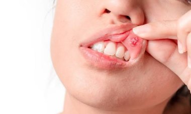 Gejala Kanker Mulut yang Kerap Tak Disadari, Termasuk Sariawan