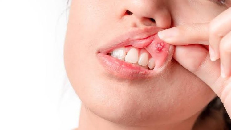 Gejala Kanker Mulut yang Kerap Tak Disadari, Termasuk Sariawan