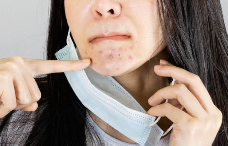 Mengenal 'Maskne', saat Jerawat Muncul karena Keseringan Pakai Masker