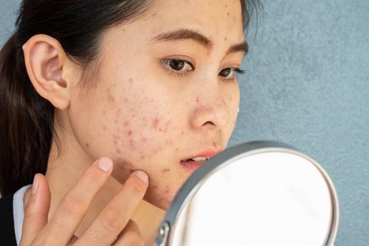 Lokasi Jerawat Bisa Menunjukkan Kondisi Kesehatan, Ini Pejelasan Dermatolog