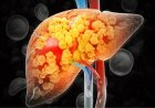Usia 30-an Banyak Kena Fatty Liver, Waspada Silent Killer