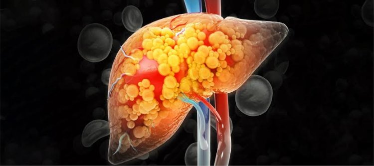 Usia 30-an Banyak Kena Fatty Liver, Waspada Silent Killer