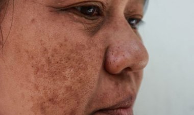 Lebih dari 90% Penderita Melasma adalah Perempuan, Ini Penyebabnya