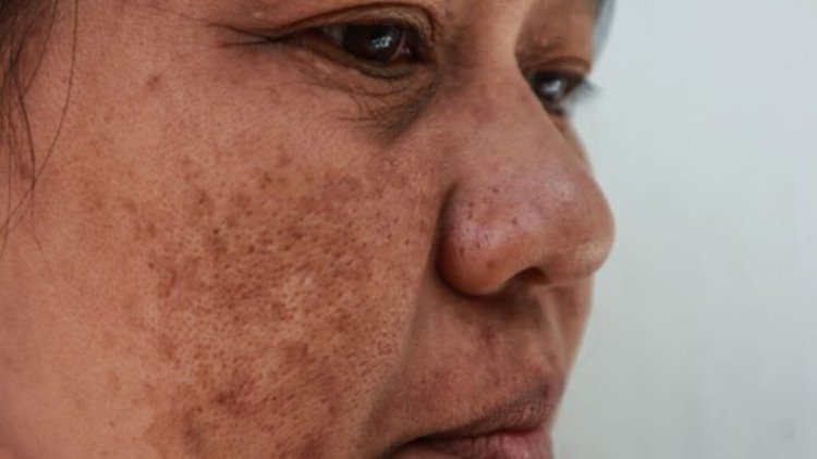 Lebih dari 90% Penderita Melasma adalah Perempuan, Ini Penyebabnya